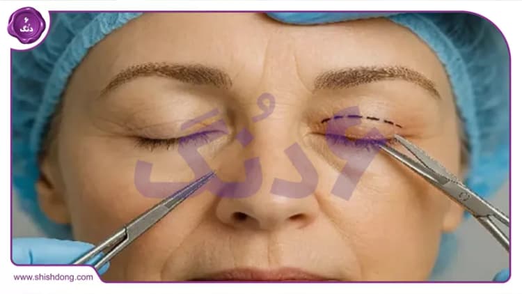 بلفاروپلاستی در جنت آباد بلفاروپلاستی در جنت آباد